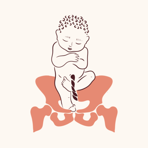 Stuitligging baby bekken